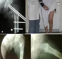 Outcomes of trochanteric external fixation for geriatric ...