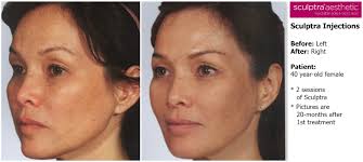 My reasoning was that people could do whatever they wanted to as long as it does not affect my life and vica versa. 12 Things I Wish I Knew Before Sculptra About Face Skincare Philadelphia Pa