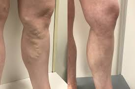 Varicose Veins Treatment Before And Afters Vein Health
