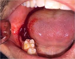 Maybe you would like to learn more about one of these? Severe Bleeding After Extraction Of The Second Mandibular Molar In A Download Scientific Diagram