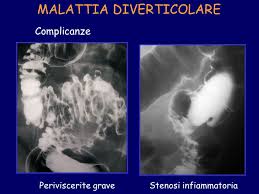In particolare, i diverticoli sono delle piccole sacche che si formano nella parete dell'intestino e con massima frequenza a livello del colon. Diverticoli Del Colon Definizione Ppt Video Online Scaricare