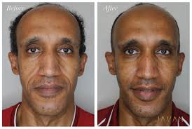 AMAZING RESULTS after just one “Make me Javan (young)” facial  treatment🤩🙌🏼. ✳️I always encourage my clients to not only get  Botox/fillers but also get facial treatments to improve skin quality and  stimulate