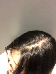 The hair follicle was being forced into the resting. Started Rogaine A Month Ago And Pretty Sure I M In The Middle Of The Dread Shed It S Fucking Great Femalehairloss