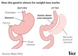 How can i restart weight loss almost 2 years after vertical sleeve surgery seems like i'm stuck or regain 1 or 3 lbs in a day than it's gone the next day. Does Bariatric Surgery Help Teens Lose Weight Jewel Tells Her Story Vox