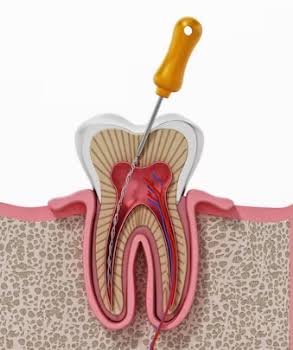 Root Canal Treatment RCT product image