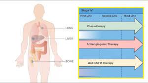 How can we treat cancer? Targeted Therapy Immunotherapy Bowel Cancer Australia