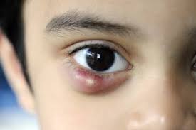 Ein hagelkorn (chalazion) ist ein kleiner, meist schmerzloser knoten oder eine umschriebene schwellung, die sich am augenlid zeigt. Hagelkorn Chalazion Und Gerstenkorn Hordeolum Augenkrankheiten Msd Manual Ausgabe Fur Patienten