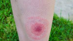 Borreliose Nach Zeckenbiss Das Sind Die Symptome Der Krankheit
