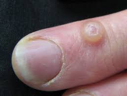A bartholin's cyst, also known as bartholin's gland cyst and bartholin's duct cyst, occurs when a causes. Cutaneous Cysts And Pseudocysts Dermnet Nz