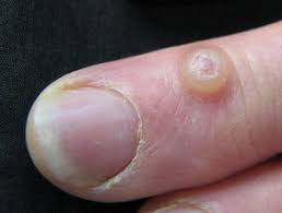 Authoritative facts from dermnet new zealand. Cutaneous Cysts And Pseudocysts Dermnet Nz