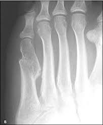 An avulsion fracture occurs when a tendon pulls a piece of bone away from the rest ice your foot for about 20 minutes every hour while awake for the first 48 hours, then 2 to 3 times a day. Metatarsal Fractures Physiopedia