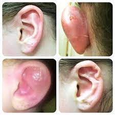 How To Treat Infected Ear Piercing How Nigeria News