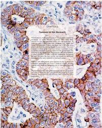 Chapter 3 Tumours Of The Stomach Pathology Outlines