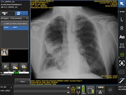Fda Clears Ge Healthcares Critical Care Suite Chest X Ray