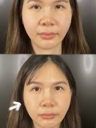 Oligio ครั้งแรกกับหมอแตมป์ ยุบเป๊ะตั้งแต่ครั้งแรก 🥰🥰 💖 Oligio 1 เครื่อง  ได้ถึง 3 เป๊ะ ✔️ คลื่นวิทยุ Monopalar RF “ ยุ บ f a t” (สลายไขมันหน้า  เหนียง) กรอบหน้าชัด ✔️ กระชับผิว รูขุมขน “ซ่อม ผิว ชั้น บน ...