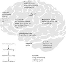 Cognitive Deficits And Associated Neurological Complications In Individuals With Down S Syndrome The Lancet Neurology