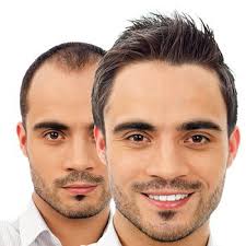 To many others, it brings to mind evidence of transplants not stopping hair loss. Standard Hair Transplant Procedure Good Clinic Vs Bad Clinic Dr Ashok Sinha Good Hair Clinic Best Hair Transplant Hair Clinic Hair Transplant Procedure