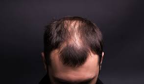 Naturliche Mittel Gegen Haarausfall Zuverlassig Bei Haarverlust