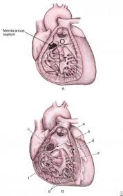 Image result for Ventricular Septal Defect