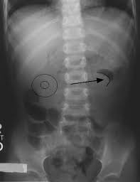 Image result for Intussusception