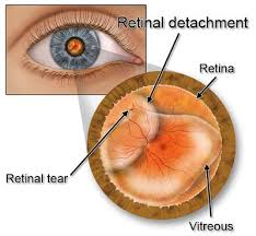 Image result for Retinal Detachment
