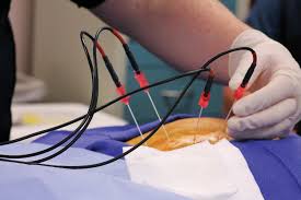 Image result for Radiofrequency Surgery