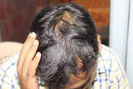 The itchiness accompanied by hair thinning is more likely caused by dermatitis, or skin irritation, chacon says. Visible Recovery In Case Of Seborrhoeic Dermatitis And Hair Fall With Homeopathy Case Study