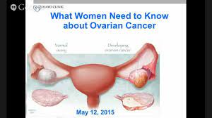 These are early signs of ovarian cancer, and even if isolated or chronic, these abdominal problems warrant a pelvic exam to check for yawn's study appears in the latest issue of the journal, mayo clinic proceedings. Interactive Webinar What Women Need To Know About Ovarian Cancer Youtube