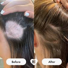 With so many pictures of using biotin before and after for hair growth you may still wonder this question can biotin work for hair growth. Buy Chewable Hair Vitamins For Hair Growth Anti Hair Loss Thinning Hair Multivitamins Skin Nails Hair Supplements For Women Biotin Hair Regrowth Pills 60 Chewy Gummy Tablets