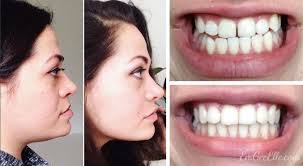 Invisible braces provided by orthodontists, are comparable in price to traditional braces. Account Suspended Double Jaw Surgery Jaw Surgery Braces Transformation