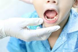 Image result for Ankyloglossia