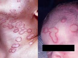 Image result for penis mycosis symptoms