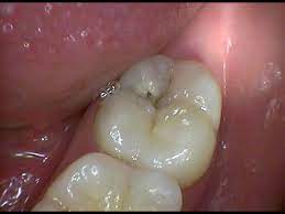 The area around the cavity is often numbed, and it takes a while for this numbness to wear off. Tooth Decay What Does A Cavity Actually Look Like Uxbridge Family Dentistry