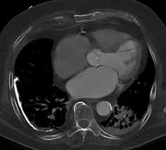 Therapies often just helps to reduce. Pleural Plaque Pacs Suche Fur Radiologen