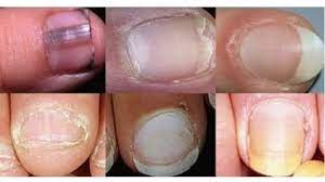 Kuku yang berwarna hitam disebabkan banyak hal, seperti kekurangan b12, masalah ginjal, atau penyakit hati. Warna Kuku Tunjukkan Kondisi Kesehatanmu Berwarna Kuning Putih Pucat Rapuh Kebiruan Atau Gelap Tribun Jambi