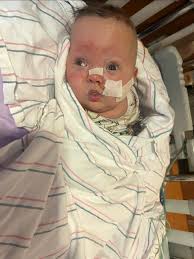 I asked a question earlier but can no longer find it and haven't had any  replies, so here goes again... does anyone know of reinfections that were  more severe (requiring hospitilization) or