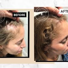 Schedule your hair transplant surgery in los angeles or any other southern california hair loss treatment office today and enjoy our discounted rates on quality hair transplants through our standby program. I Tried It Harklinikken The Scandinavian Hair Growth System Everyone S Buzzing About