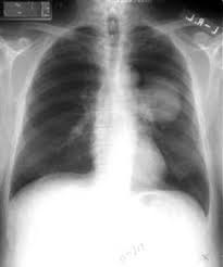 Weight loss is also almost universal, and it occurs even when people are eating a diet with adequate calories. Non Small Cell Lung Cancer Nsclc Imaging Practice Essentials Radiography Computed Tomography