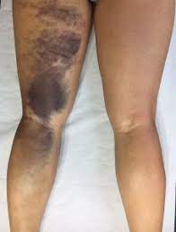A hamstring strain can be very painful. Bruising Phact The Proximal Hamstring Avulsion Clinical Trial