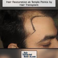 Hair Restoration At Temple Points By Hair Transplant Hair Transplant Hair Restoration Transplant