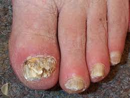 Image result for onychomycosis