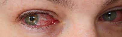 Image result for Bacterial Conjunctivitis