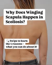 Image result for Winged Scapula
