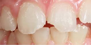 Behandlungsbeispiel Veneers Bei Abgebrochenen Schneidekanten