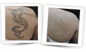 2,596 likes · 547 talking about this. Tattoo Removal Medispa S10 Sheffield Advanced Skin Science