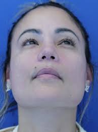 Dorsal Preservation and Narrow Base 6758