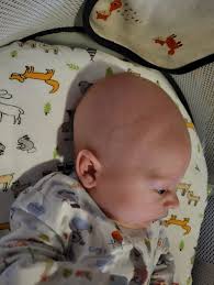 My son is now 6 months I've always been concerned over my son's head shape  since birth being large at the back and sticks out abit, I've been looking  online and come