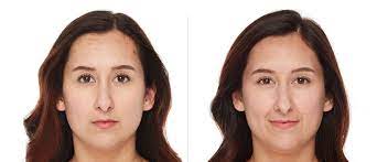 To help you remember, use it at the same time each day. Differin Before And After Results Differin Gel