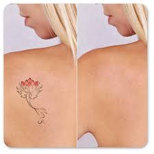 See more ideas about laser removal, tattoo removal, old tattoos. Picoway Tattoo Removal In Vienna Va Laser Tattoo Removal