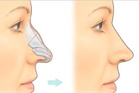 Nose job surgery involves structural modifications of nasal cartilages and bone to enhance the. Nasal Hump London Rhinoplasty